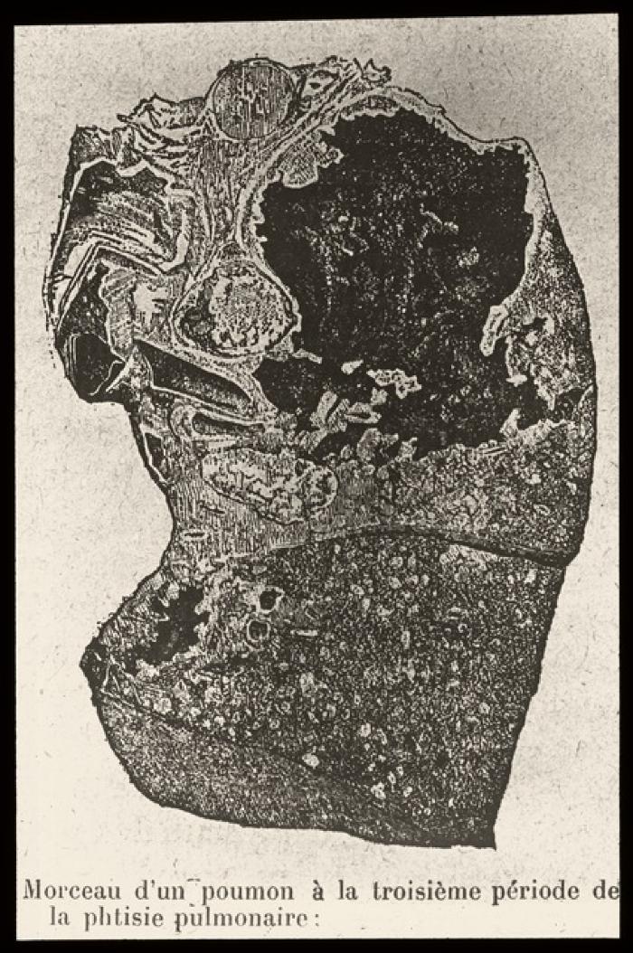 Document médical, dessin de poumons représentant les différentes étapes de la tuberculose/phtisie pulmonaire.